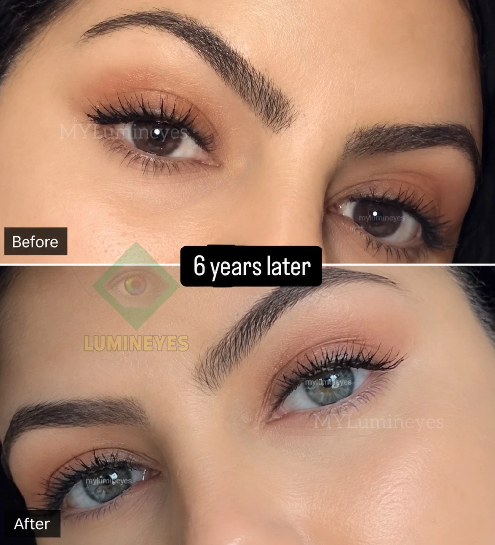Long-term before and after results of a patient 6 years after the Lumineyes laser eye color change procedure.