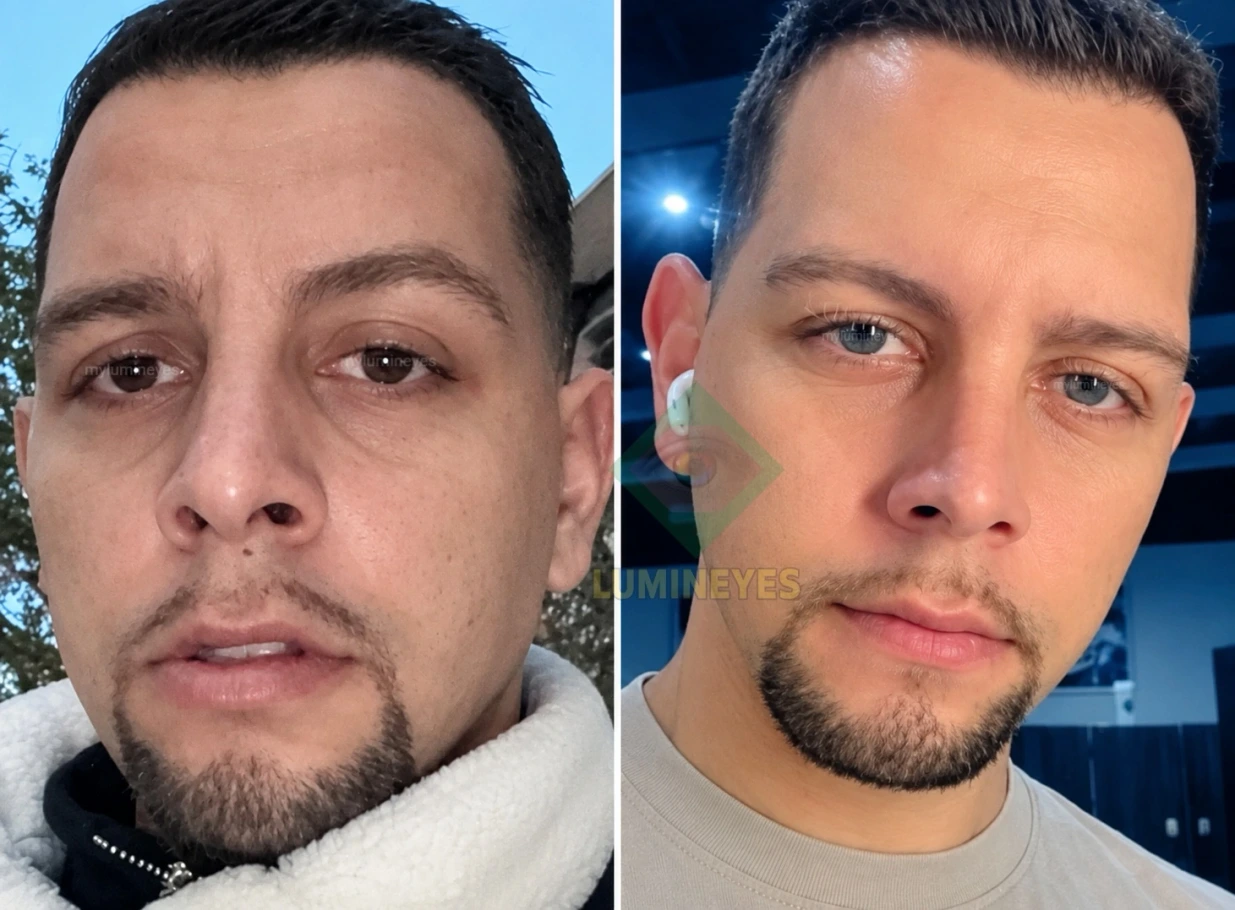 Successful laser eye color change before and after result on a patient at Mylumineyes clinic.