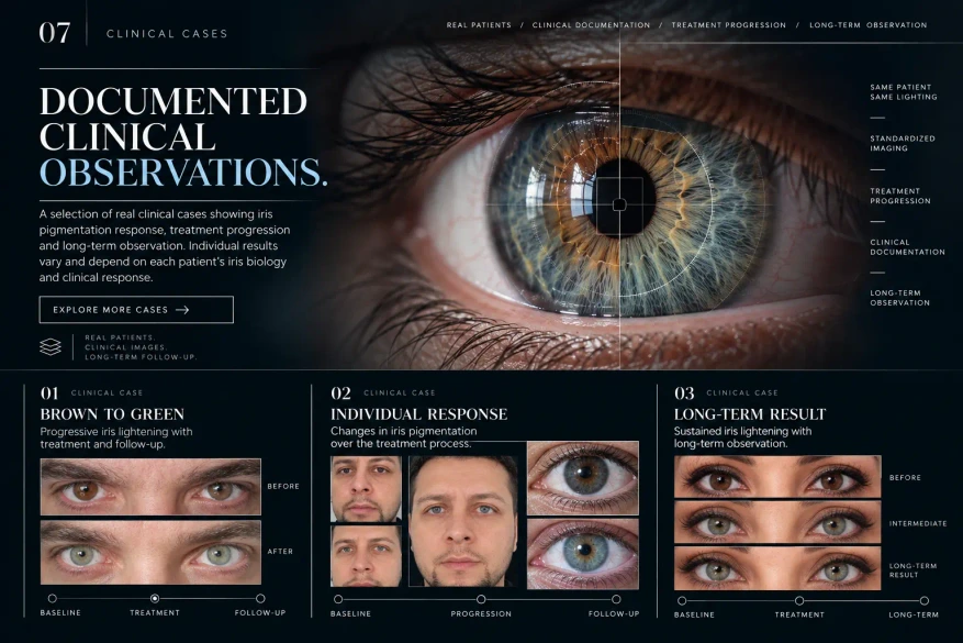 MyLumineyes clinical iris cases illustrating treatment-related changes in eye color