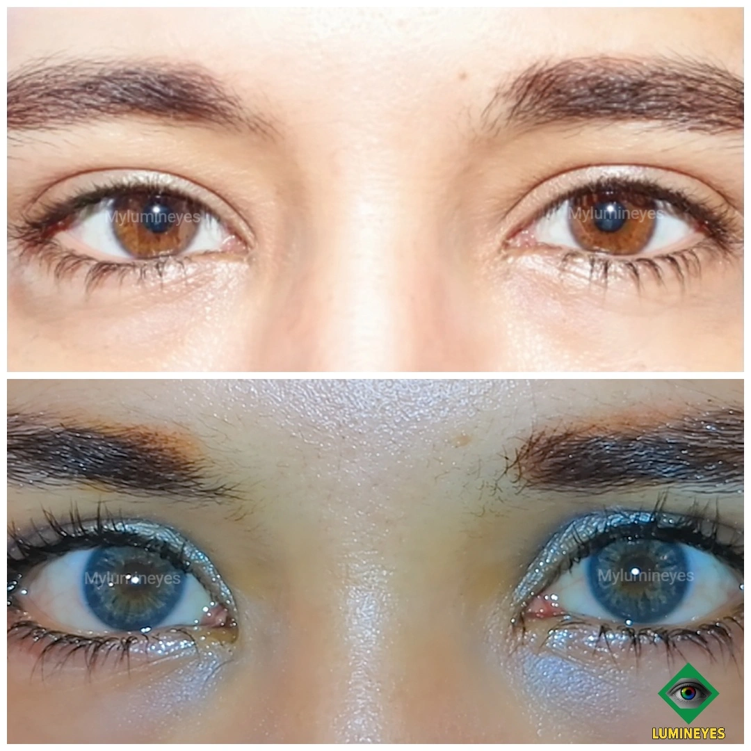 Brown to blue iris appearance after MyLumineyes laser eye color change treatment, shown in before-and-after patient photographs.
