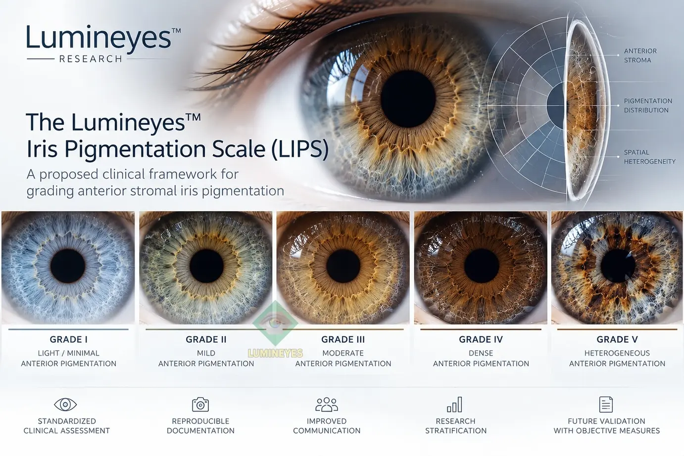 Lumineyes Iris Pigmentation Scale LIPS clinical framework showing Grades I–IV diffuse anterior stromal pigmentation and Grade V spatial heterogeneity