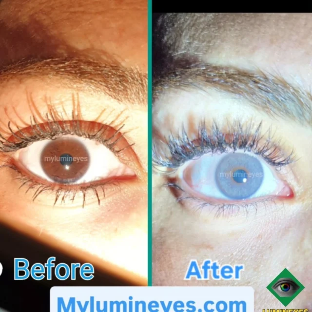 Before After Eye Color Surgery Photos In Turkey